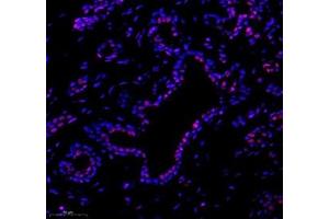 Immunofluorescence of paraffin embedded human breast cancer using tfiib (ABIN7074034) at dilution of 1: 500 (300x lens) (GTF2B Antikörper)