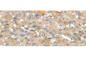 Immunohistochemistry of paraffin-embedded Human liver cancer tissue using SRP54 Polyclonal Antibody at dilution 1:45 (SRP54 Antikörper)