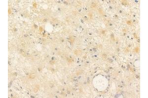 ABIN6254897 and ABIN6266562 at 1/100 staining human astrocytoma by IHC-P.