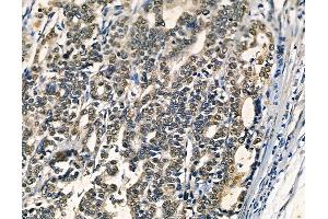 ABIN6262948 and ABIN6278588 at 1/100 staining human pancreatic cancer by IHC-P. (GAL4 Antikörper  (N-Term))