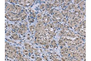 The image on the left is immunohistochemistry of paraffin-embedded Human thyroid cancer tissue using ABIN7129455(FAR2 Antibody) at dilution 1/50, on the right is treated with fusion protein. (FAR2 Antikörper)