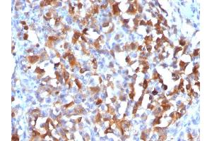 Formalin-fixed, paraffin-embedded human Melanoma stained with MART-1 Rabbit Polyclonal Antibody. (MLANA Antikörper)