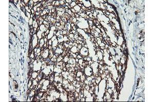 Immunohistochemical staining of paraffin-embedded Adenocarcinoma of Human breast tissue using anti-ERBB2 mouse monoclonal antibody.
