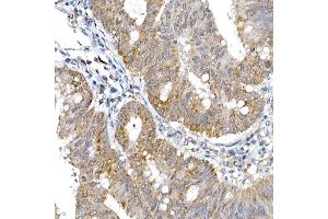 Immunohistochemistry of paraffin-embedded human colon carcinoma using SRP72 Rabbit pAb (ABIN6134166, ABIN6148452, ABIN7101299 and ABIN7101300) at dilution of 1:100 (40x lens). (SRP72 Antikörper)