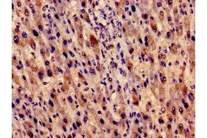 Immunocytochemistry analysis of human liver cancer using ABIN7151520 at dilution of 1:100 (EVC Antikörper  (AA 493-602))