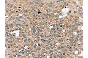 The image on the left is immunohistochemistry of paraffin-embedded Human breast cancer tissue using ABIN7130823(RASGEF1A Antibody) at dilution 1/20, on the right is treated with fusion protein. (RASGEF1A Antikörper)