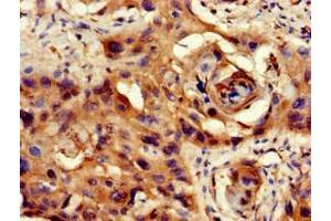 Immunohistochemistry of paraffin-embedded human cervical cancer using ABIN7169308 at dilution of 1:100 (PPP1CB Antikörper  (Catalytic Subunit))