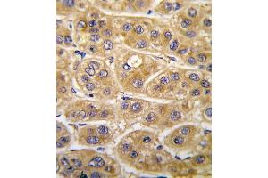 Formalin-fixed and paraffin-embedded human hepatocarcinoma tissue reacted with AGT antibody (C-term), which was peroxidase-conjugated to the secondary antibody, followed by DAB staining. (AGT Antikörper  (C-Term))