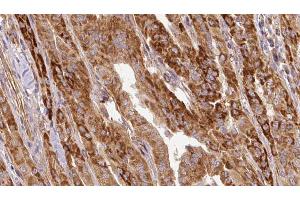 ABIN6267124 at 1/100 staining Human thyroid cancer tissue by IHC-P.