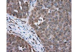 Immunohistochemical staining of paraffin-embedded colon tissue using anti-ERCC1 mouse monoclonal antibody. (ERCC1 Antikörper)