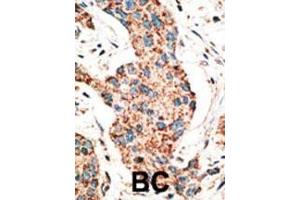 Formalin-fixed and paraffin-embedded human cancer tissue reacted with the primary antibody, which was peroxidase-conjugated to the secondary antibody, followed by AEC staining. (RAD9A Antikörper  (AA 1-30))