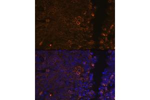 Immunofluorescence analysis of human cervix cancer using Cytokeratin 13 (KRT13) (KRT13) Rabbit mAb (ABIN7268089) at dilution of 1:100 (40x lens). (Cytokeratin 13 Antikörper)