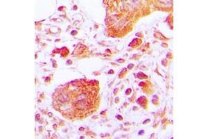 Immunohistochemical analysis of PLC gamma 1 (pY783) staining in human lung cancer formalin fixed paraffin embedded tissue section. (Phospholipase C gamma 1 Antikörper  (pTyr783))