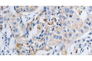 Immunohistochemistry of paraffin-embedded Human lung cancer tissue using GRIA3 Polyclonal Antibody at dilution 1:50 (Glutamate Receptor 3 Antikörper)
