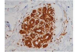 Immunohistochemistry (IHC) image for anti-Insulin-Like Growth Factor 1 Receptor (IGF1R) (pTyr1346) antibody (ABIN6256637)
