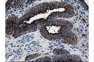 Immunohistochemical staining of paraffin-embedded Adenocarcinoma of Human endometrium tissue using anti-DTYMK mouse monoclonal antibody. (DTYMK Antikörper)