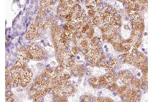 ABIN6267633 at 1/100 staining human liver carcinoma tissue sections by IHC-P. (PAK1 Antikörper  (pThr212))