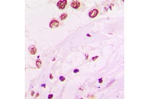 Immunohistochemical analysis of HKR1 staining in human lung cancer formalin fixed paraffin embedded tissue section. (HKR1 Antikörper  (Center))