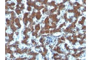 IHC testing of FFPE human hepatocellular carcinoma and RBP antibody (clone G4E4). (RBP1 Antikörper  (AA 74-182))