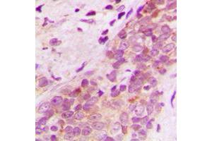 Immunohistochemical analysis of AIP-1 staining in human breast cancer formalin fixed paraffin embedded tissue section. (WDR1 Antikörper  (Center))