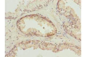 Immunohistochemistry of paraffin-embedded human prostate cancer using ABIN7173695 at dilution of 1:100 (TUBb6 Antikörper  (AA 1-446))