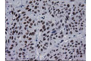 Immunohistochemical staining of paraffin-embedded Carcinoma of Human bladder tissue using anti-MYD88 mouse monoclonal antibody. (MYD88 Antikörper)
