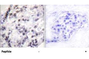 Immunohistochemistry analysis of paraffin-embedded human breast carcinoma tissue using HNRNPC polyclonal antibody . (HNRNPC Antikörper  (Ser260))