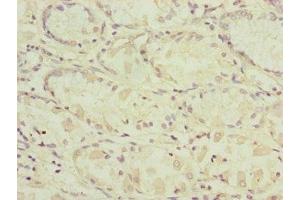 Immunohistochemistry of paraffin-embedded human gastric cancer using ABIN7164324 at dilution of 1:100 (RARS2 Antikörper  (AA 17-340))