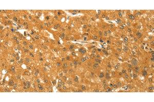 Immunohistochemistry of paraffin-embedded Human liver cancer using TM7SF2 Polyclonal Antibody at dilution of 1:30 (TM7SF2 Antikörper)