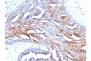 Formalin-fixed, paraffin-embedded human Ovarian Carcinoma stained with TAG-72 Mouse Monoclonal Antibody (B72. (TAG-72 / CA72.4 Antikörper)