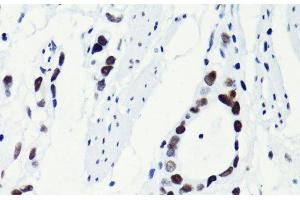 Immunohistochemistry of paraffin-embedded Human gastric cancer using Acetyl-Histone H2B-K5 Polyclonal Antibody at dilution of 1:100 (40x lens). (Histone H2B Antikörper  (acLys5))