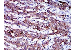 Immunohistochemical analysis of paraffin-embedded human cervical cancer tissues using KRT19 mouse mAb with DAB staining.