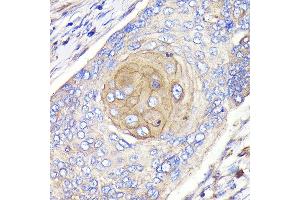 Immunohistochemistry of paraffin-embedded human esophageal cancer using FGFR3 Rabbit mAb (ABIN7267191) at dilution of 1:100 (40x lens). (FGFR3 Antikörper)