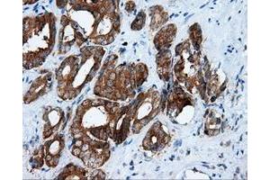 Immunohistochemical staining of paraffin-embedded Adenocarcinoma of ovary tissue using anti-RALBP1 mouse monoclonal antibody.