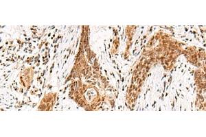Immunohistochemistry of paraffin-embedded Human esophagus cancer tissue using DGCR6L Polyclonal Antibody at dilution of 1:65(x200) (DGCR6L Antikörper)