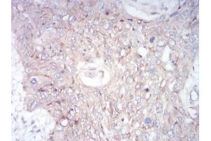 Immunohistochemical analysis of paraffin-embedded esophageal cancer tissues using GLI1 mouse mAb with DAB staining.