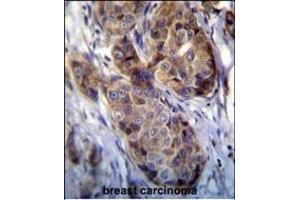 GEA12 antibody (N-term) (ABIN390104 and ABIN2840616) immunohistochemistry analysis in forlin fixed and paraffin embedded hun breast carcino followed by peroxidase conjugation of the secondary antibody and DAB staining. (MAGEA12 Antikörper  (N-Term))