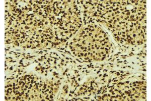 ABIN6274755 at 1/100 staining Human breast cancer tissue by IHC-P. (RPS3 Antikörper  (Internal Region))