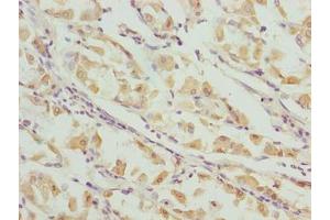 Immunohistochemistry of paraffin-embedded human gastric cancer using ABIN7156409 at dilution of 1:100 (Integrator Complex Subunit 14 (INTS14) (AA 231-518) Antikörper)