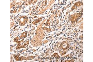 Immunohistochemistry of Human gastric cancer using CCL17 Polyclonal Antibody at dilution of 1:70 (CCL17 Antikörper)