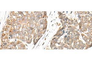 Immunohistochemistry of paraffin-embedded Human thyroid cancer tissue using COA7 Polyclonal Antibody at dilution of 1:55(x200) (C1orf163 Antikörper)