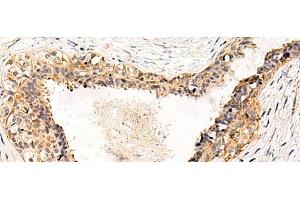 Immunohistochemistry of paraffin-embedded Human breast cancer tissue using GPR152 Polyclonal Antibody at dilution of 1:55(x200) (GPR152 Antikörper)