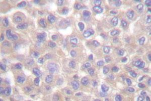 Immunohistochemical analysis of paraffin-embedded human breast cancer tissue using TRADD polyclonal antibody . (TRADD Antikörper)