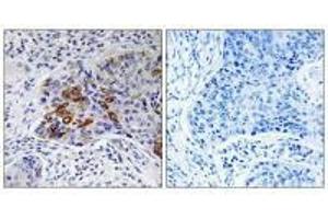 Immunohistochemistry analysis of paraffin-embedded human lung carcinoma tissue, using ADCY9 antibody. (ADCY9 Antikörper  (N-Term))