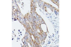 Immunohistochemistry of paraffin-embedded human colon carcinoma using L1 Rabbit pAb (ABIN6134555, ABIN6137248, ABIN6137250 and ABIN6215529) at dilution of 1:100 (40x lens). (ATG16L1 Antikörper  (AA 200-300))