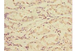Immunohistochemistry of paraffin-embedded human gastric cancer using ABIN7172004 at dilution of 1:100