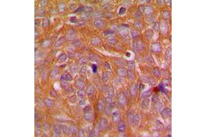 Immunohistochemical analysis of CARD14 staining in human breast cancer formalin fixed paraffin embedded tissue section.
