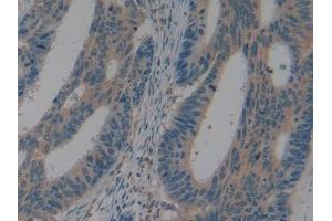 IHC-P analysis of Human Colorectal cancer Tissue, with DAB staining. (LAP Antikörper  (AA 320-519))