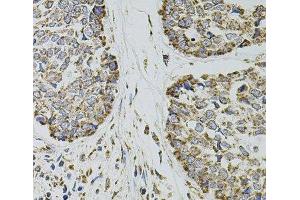 Immunohistochemistry of paraffin-embedded Human esophageal cancer using SELP Polyclonal Antibody at dilution of 1:100 (40x lens). (P-Selectin Antikörper)