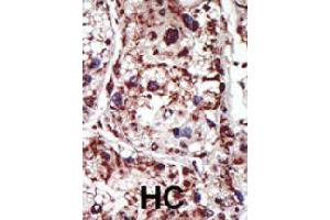Formalin-fixed and paraffin-embedded human hepatocellular carcinoma tissue reacted with PACSIN1 polyclonal antibody  , which was peroxidase-conjugated to the secondary antibody, followed by DAB staining. (PACSIN1 Antikörper  (Internal Region))